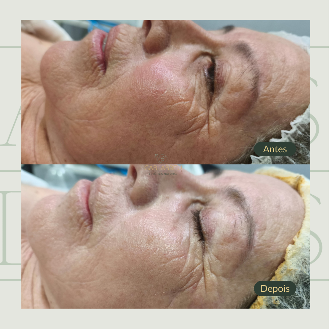 Resultado antes e depois — cliente 1