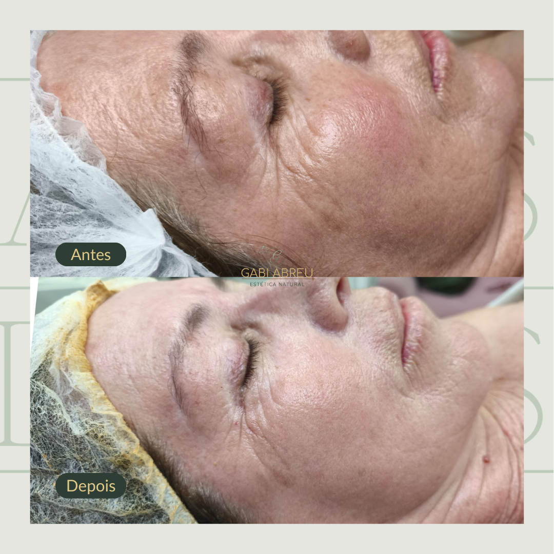 Resultado antes e depois — cliente 1