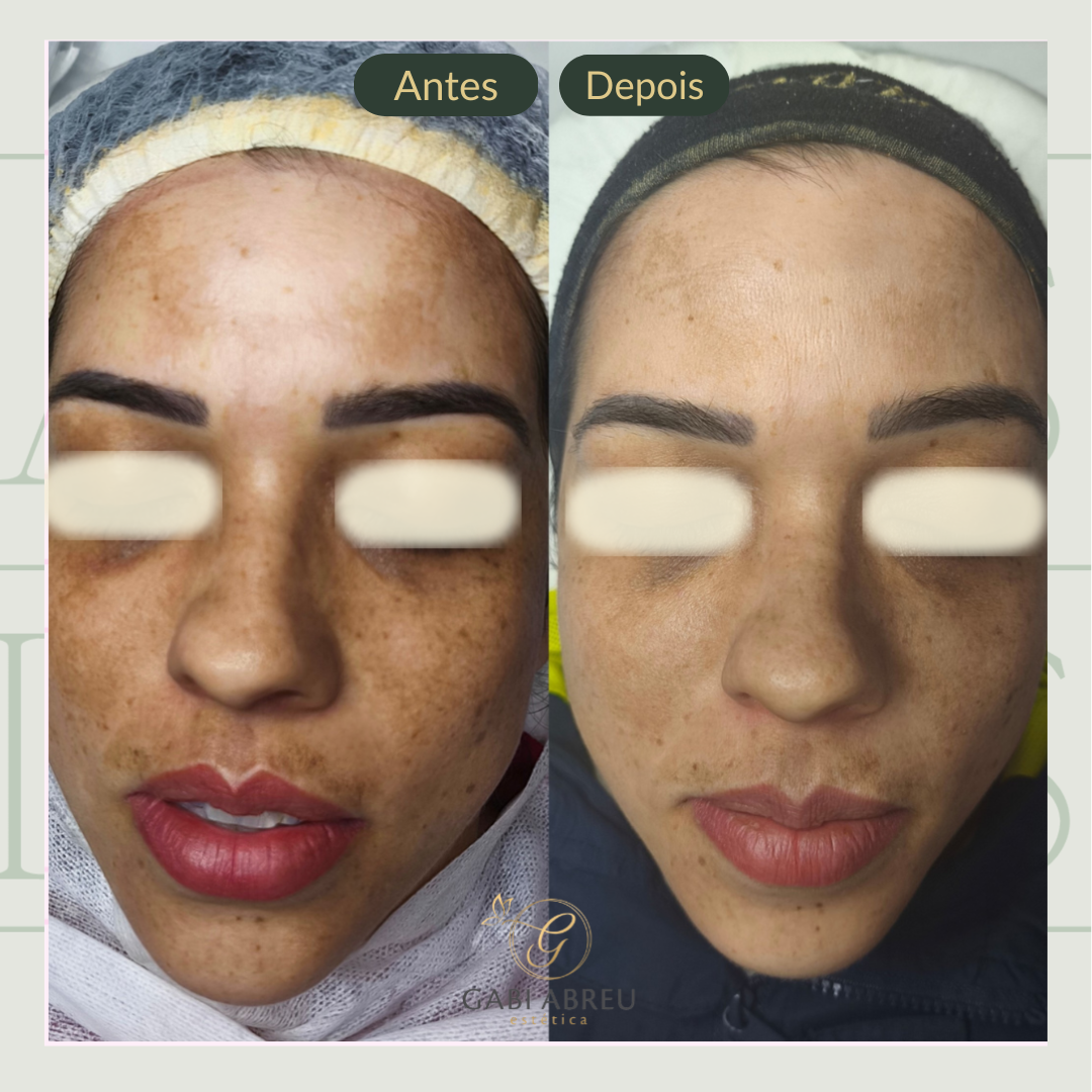 Resultado antes e depois — cliente 4