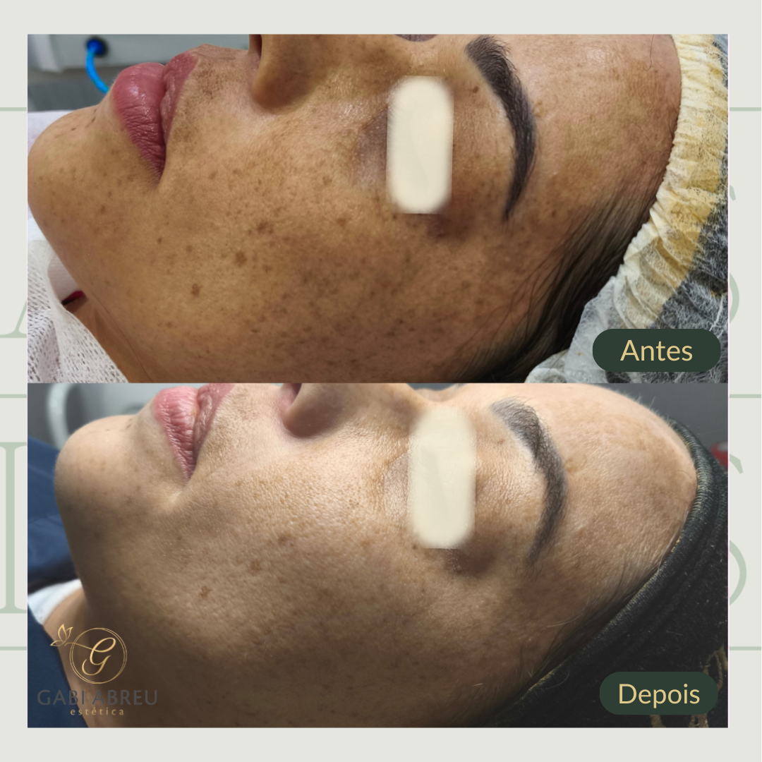 Resultado antes e depois — cliente 4