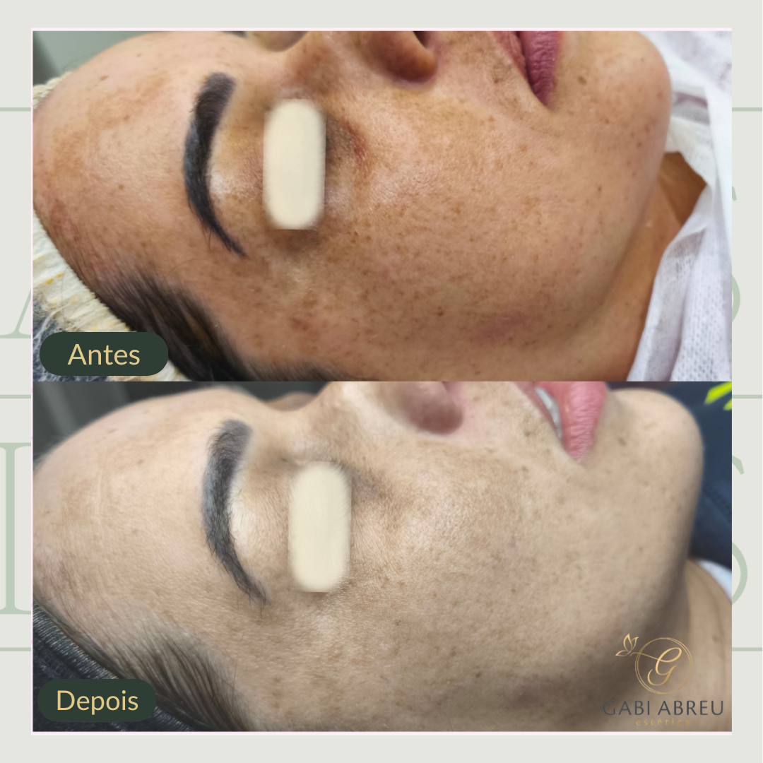 Resultado antes e depois — cliente 4