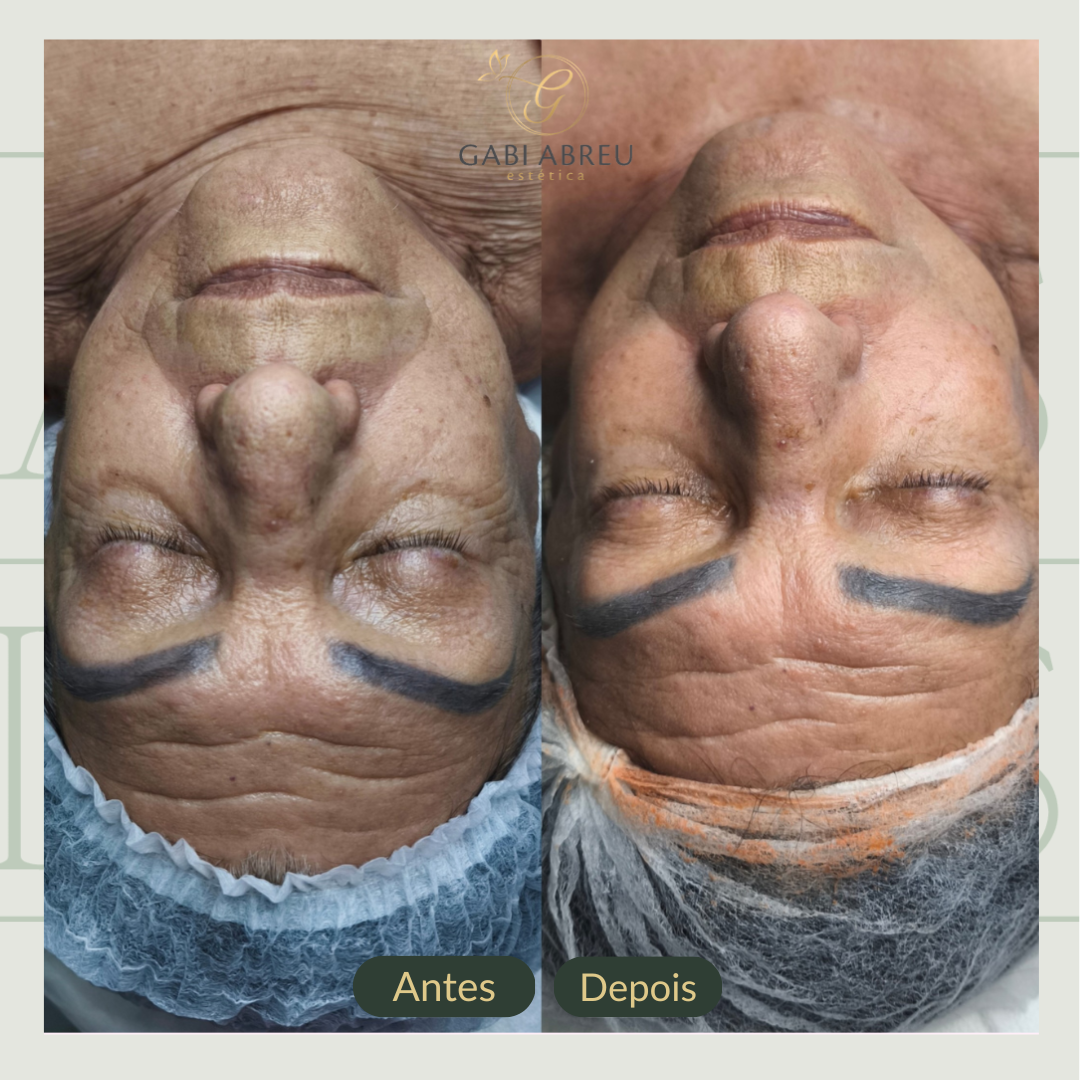 Resultado antes e depois — cliente 5