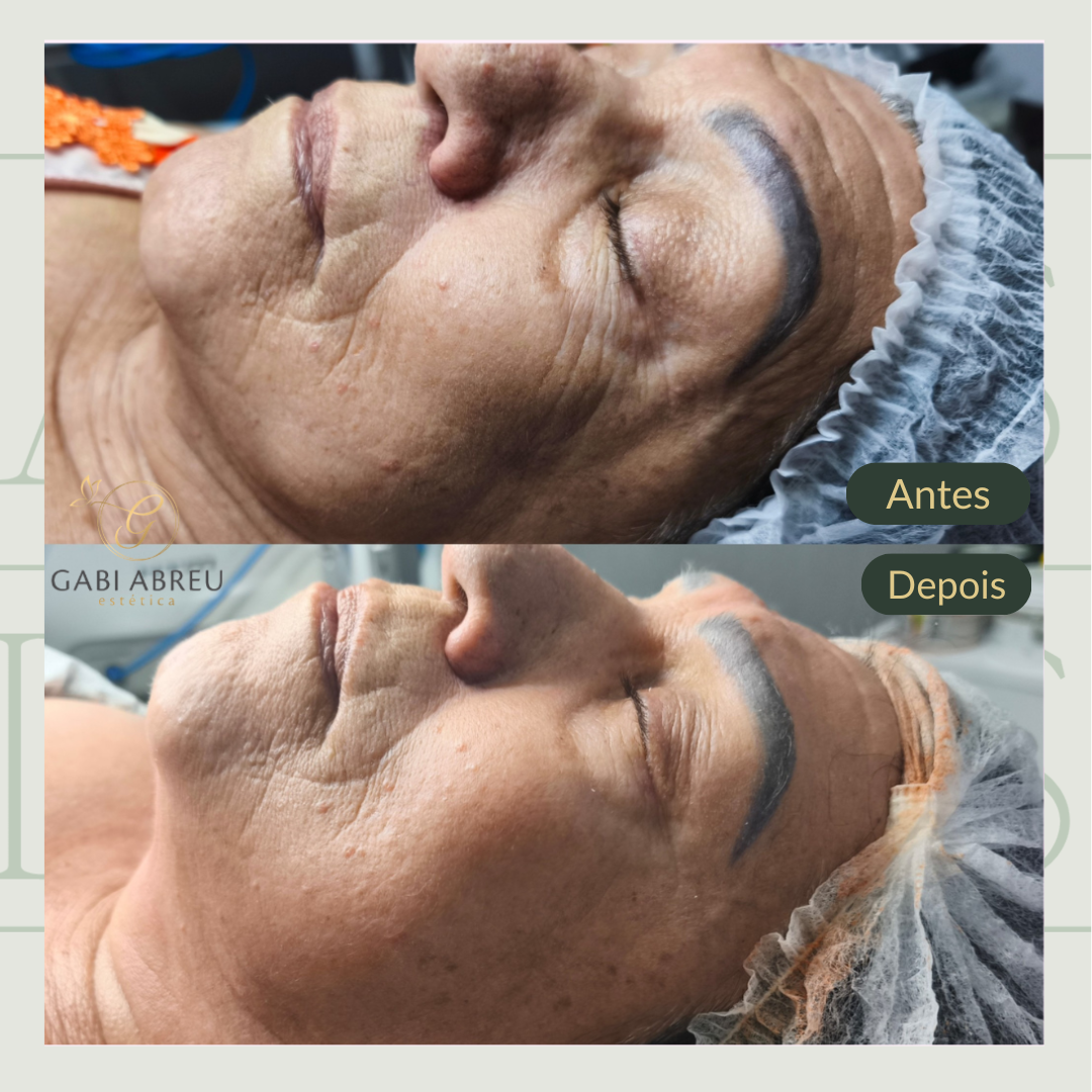 Resultado antes e depois — cliente 5