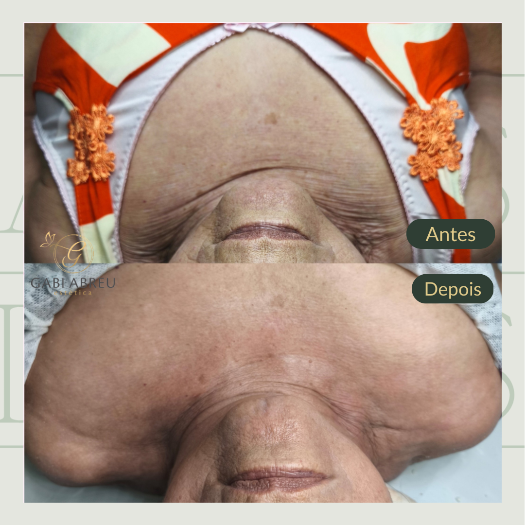 Resultado antes e depois — cliente 5