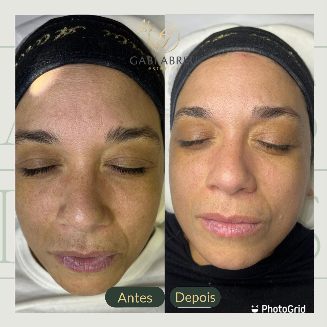 Resultado antes e depois — cliente 6