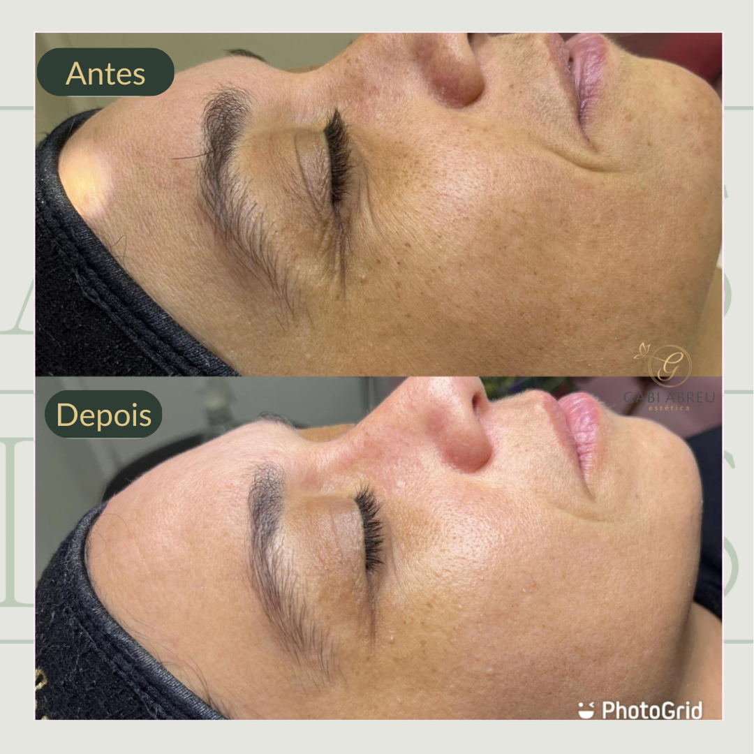 Resultado antes e depois — cliente 6