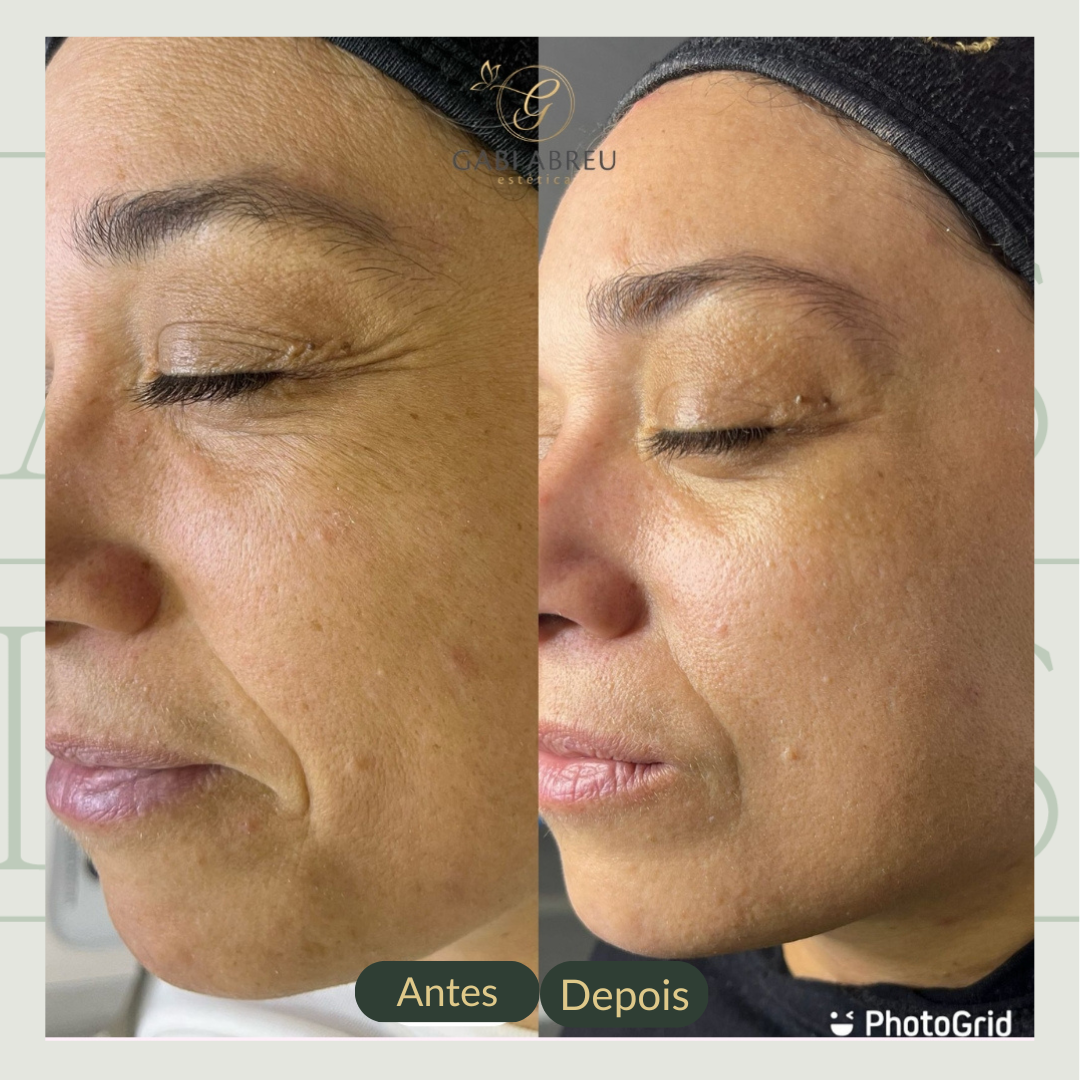 Resultado antes e depois — cliente 6